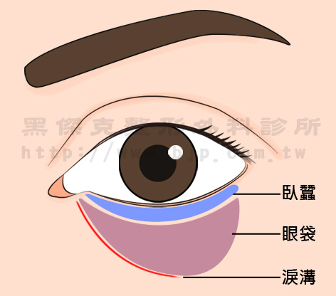 眼袋：因眼周韌帶筋膜鬆弛、支撐力不足，導致脂肪被眼球擠壓所形成的區塊浮腫袋狀物。